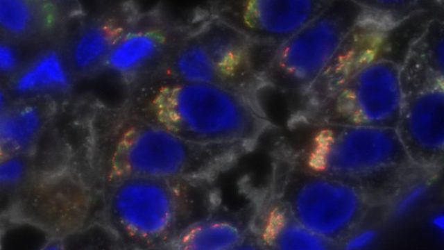 This sample of clinical triple-negative breast cancer is stained for bone morphogenetic protein-11 (red); the Golgi marker GM130 (green); glycosylated proteins (white); and nuclei (blue), Cancer cells exhibit a wide variety of molecular structures and characteristics, posing difficult challenges for researchers trying to find better ways of managing the disease. Courtesy National Cancer Institute/University of Virginia Cancer Center.